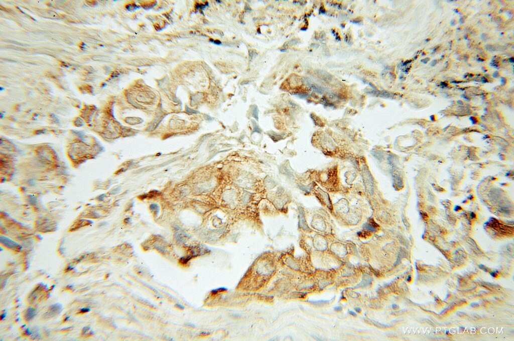 IHC staining of human lung cancer using 10061-1-AP