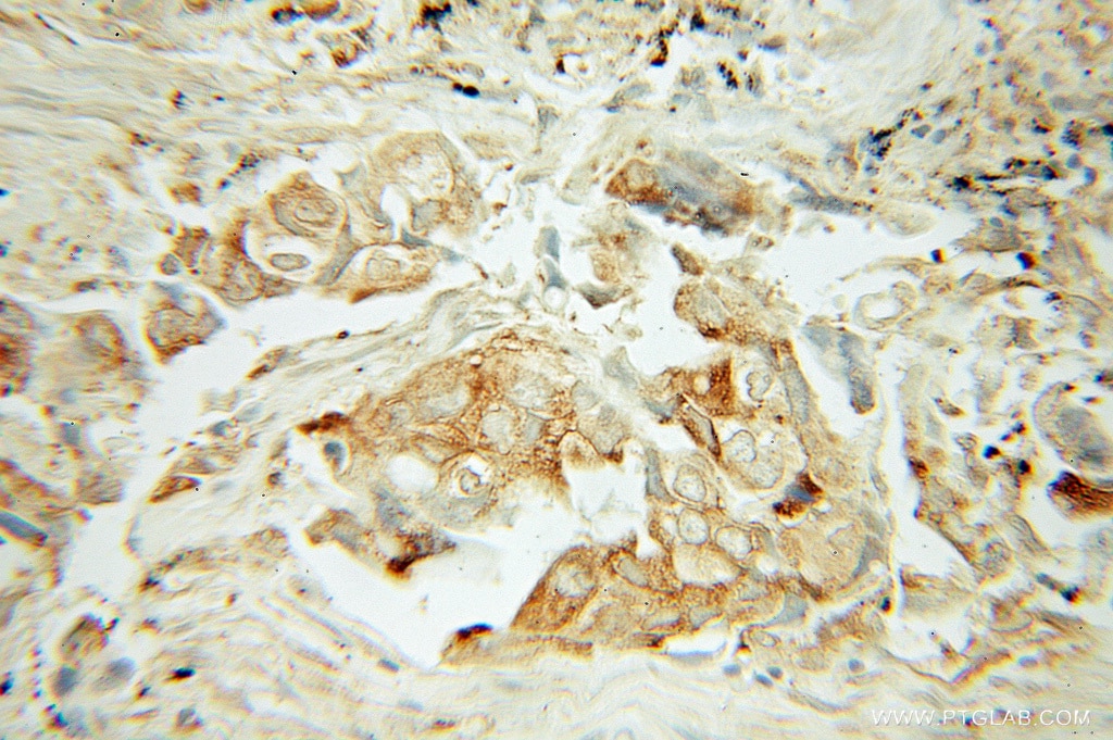 Immunohistochemistry (IHC) staining of human lung cancer tissue using OS9 Polyclonal antibody (10061-1-AP)