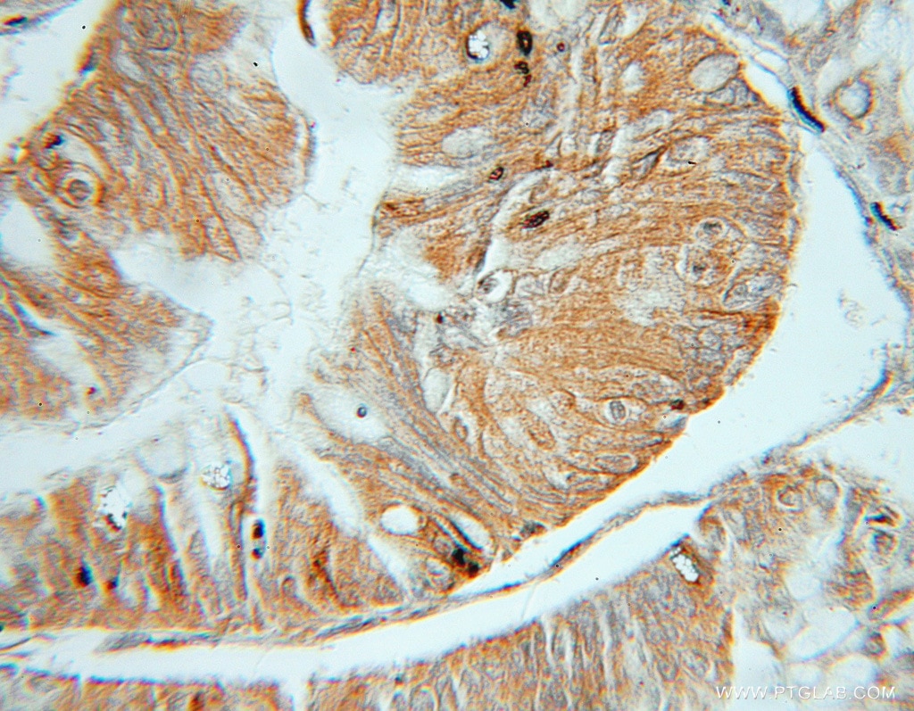Immunohistochemistry (IHC) staining of human ovary tumor tissue using OSBP Polyclonal antibody (11096-1-AP)