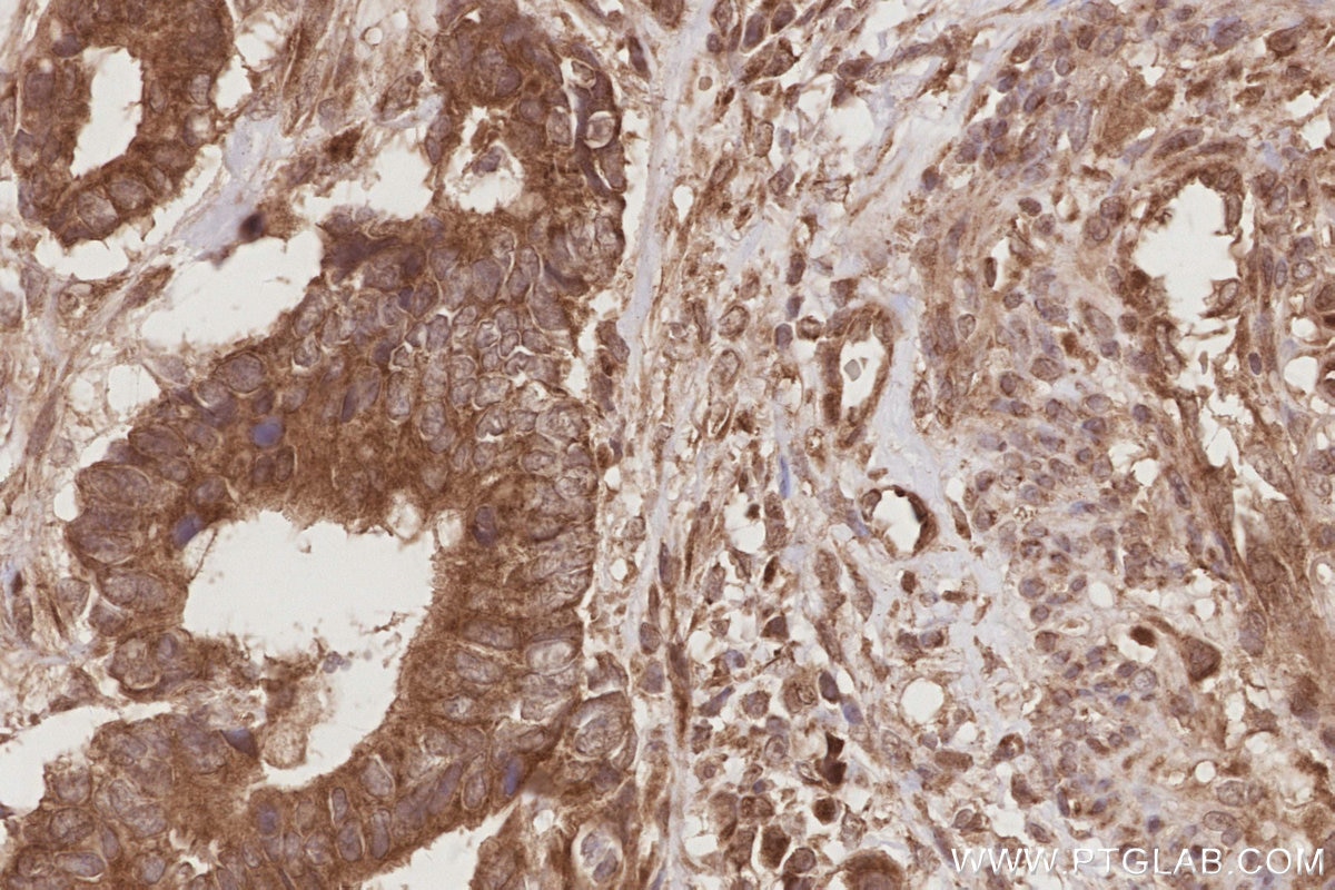 Immunohistochemistry (IHC) staining of human rectal cancer tissue using OSBPL10 Polyclonal antibody (15491-1-AP)