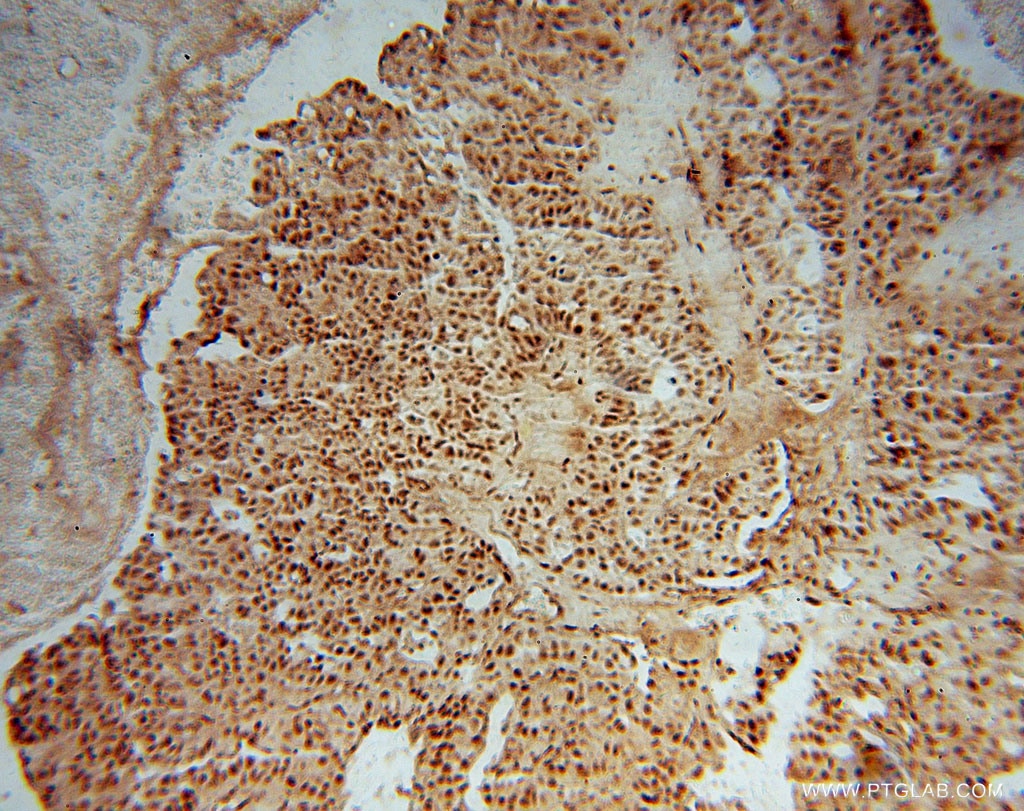 Immunohistochemistry (IHC) staining of human colon cancer tissue using OSBPL10 Polyclonal antibody (15491-1-AP)