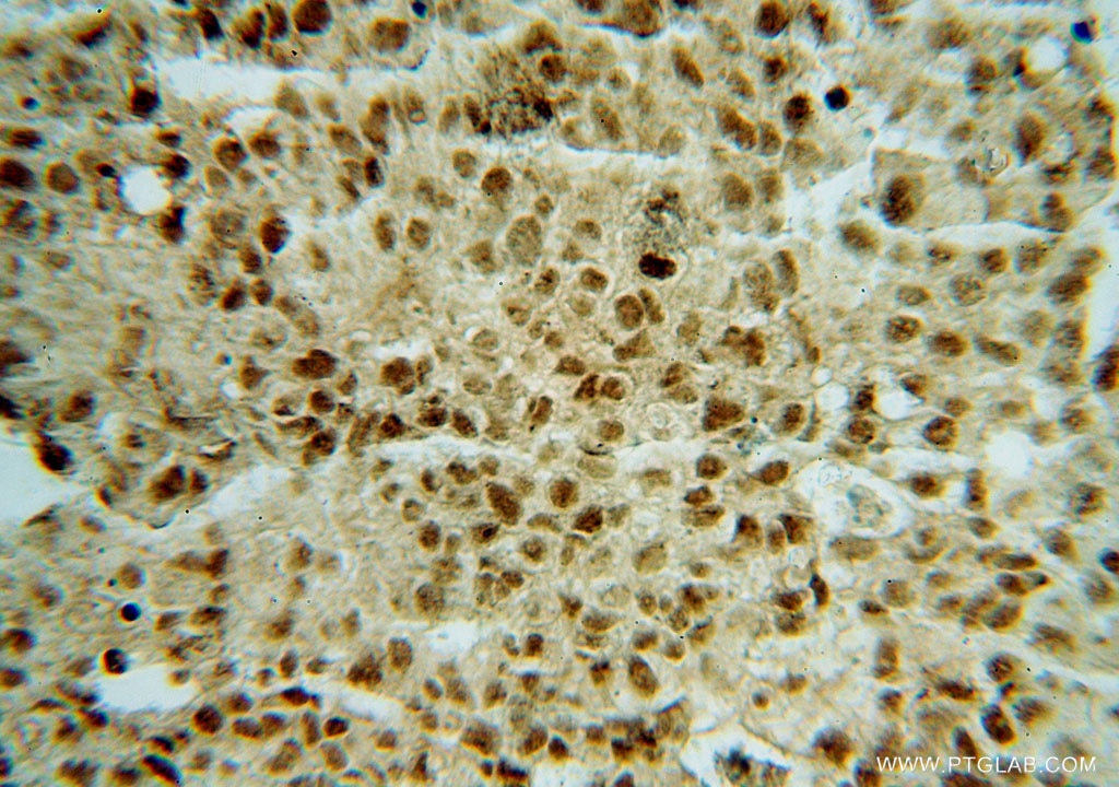 Immunohistochemistry (IHC) staining of human colon cancer tissue using OSBPL10 Polyclonal antibody (15491-1-AP)