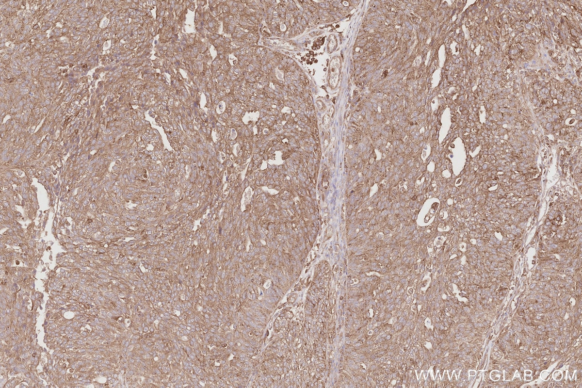 IHC staining of human ovary cancer using 11318-1-AP Immunohistochemistry (IHC) staining of human ovary cancer tissue using OSBPL11 Polyclonal antibody (11318-1-AP)