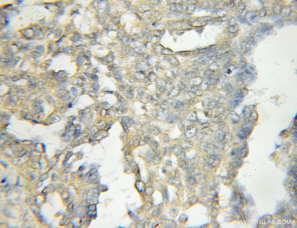 Immunohistochemistry (IHC) staining of human ovary tumor tissue using OSBPL11 Polyclonal antibody (11318-1-AP)