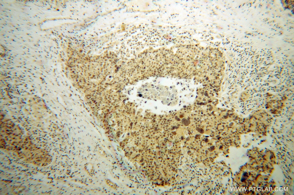 Immunohistochemistry (IHC) staining of human ovary tumor tissue using OSBPL2 Polyclonal antibody (14751-1-AP)