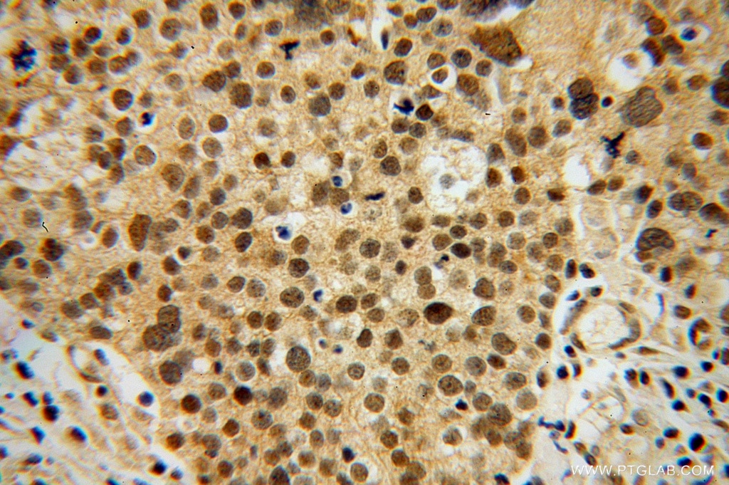 IHC staining of human ovary tumor using 14751-1-AP