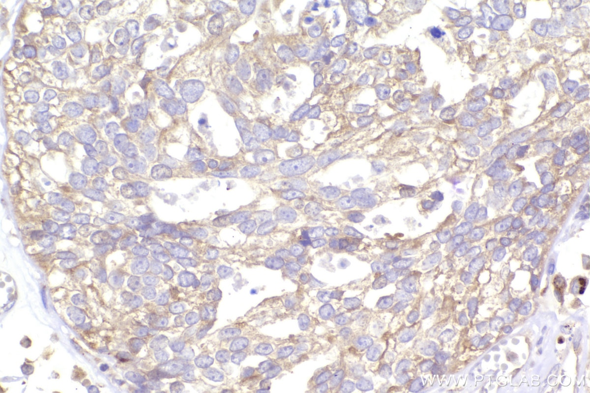 Immunohistochemistry (IHC) staining of human ovary cancer tissue using OSBPL3 Polyclonal antibody (12417-1-AP)