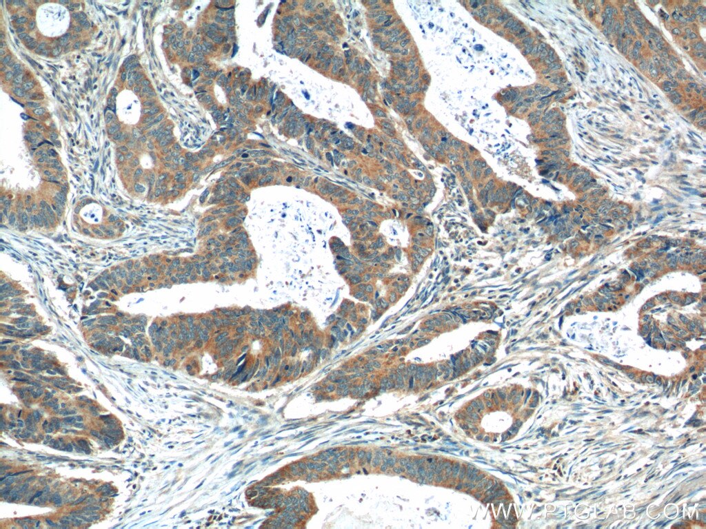 Immunohistochemistry (IHC) staining of human colon cancer tissue using OSBPL3 Polyclonal antibody (12417-1-AP)