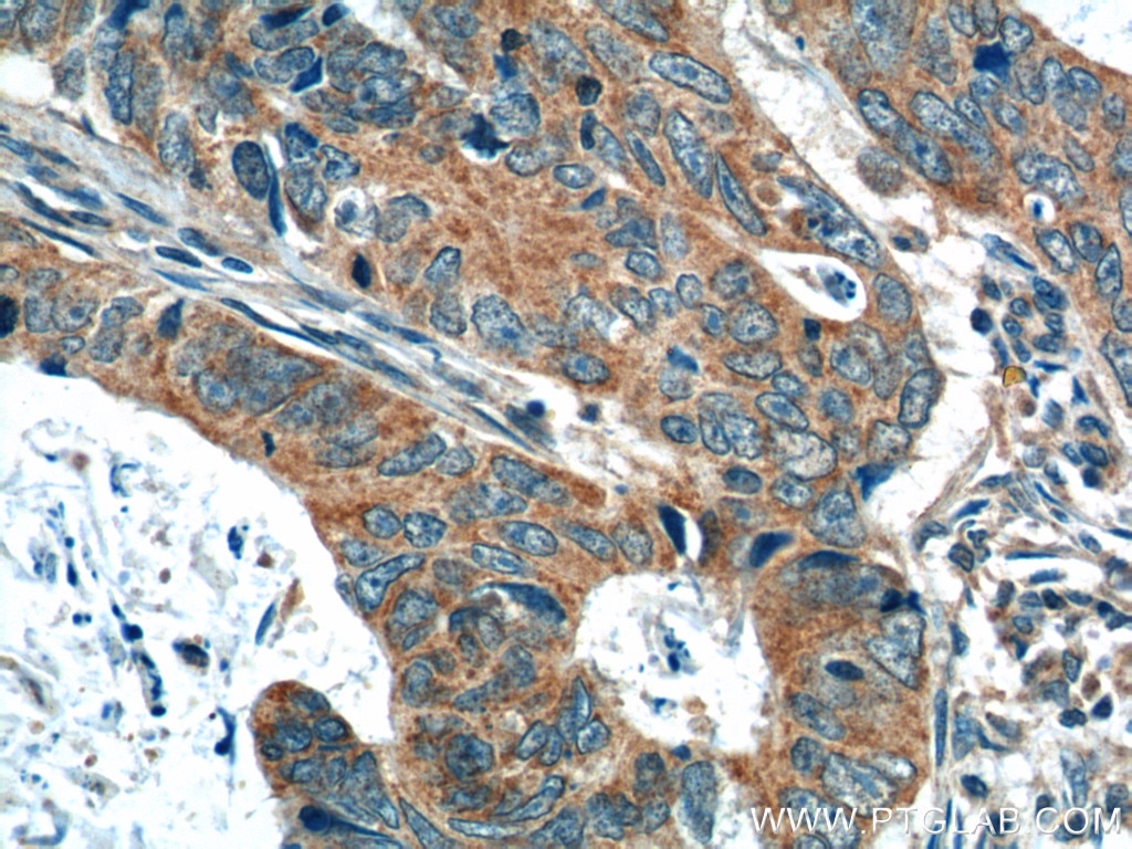 Immunohistochemistry (IHC) staining of human colon cancer tissue using OSBPL3 Polyclonal antibody (12417-1-AP)