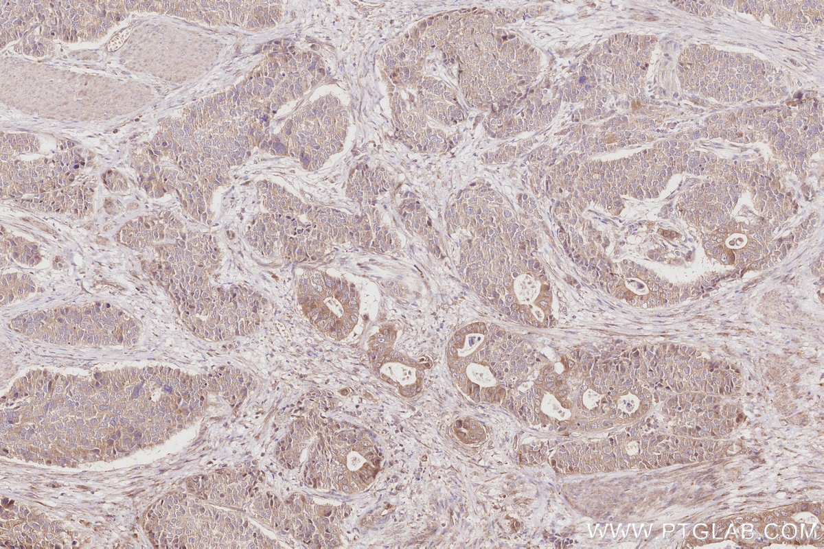Immunohistochemistry (IHC) staining of human stomach cancer tissue using OSBPL5 Polyclonal antibody (27870-1-AP)