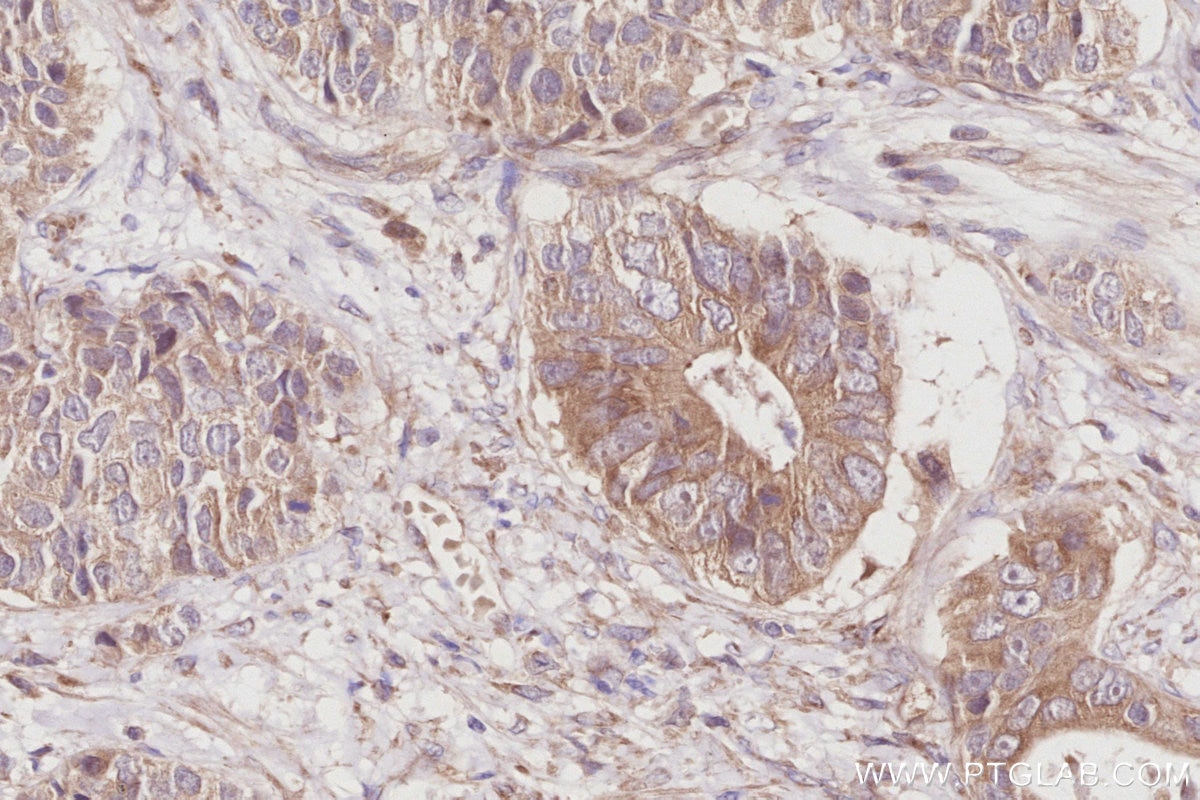 Immunohistochemistry (IHC) staining of human stomach cancer tissue using OSBPL5 Polyclonal antibody (27870-1-AP)