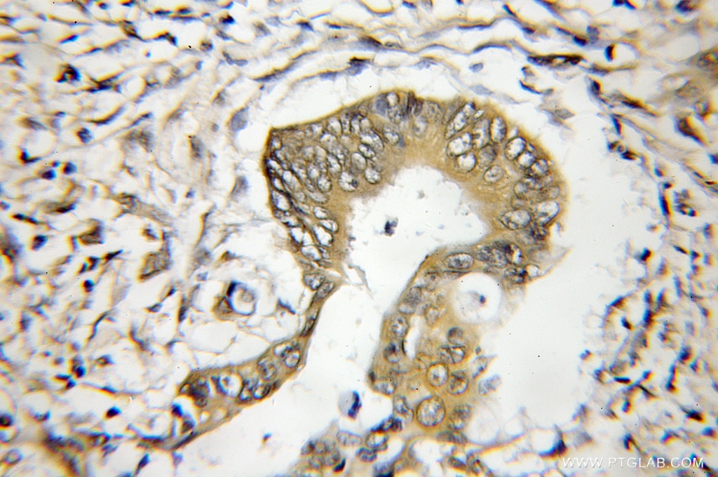 IHC staining of human colon cancer using 11879-1-AP