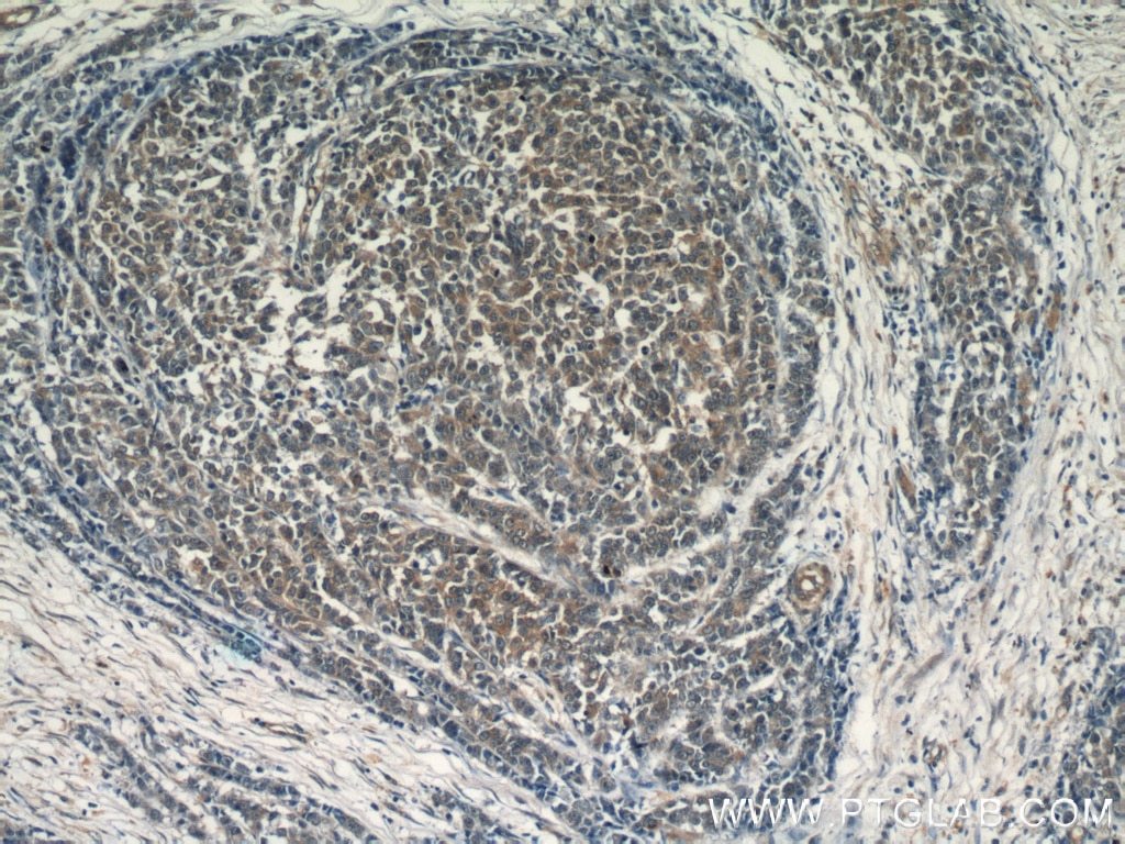Immunohistochemistry (IHC) staining of human colon cancer tissue using OSBPL9 Polyclonal antibody (11879-1-AP)