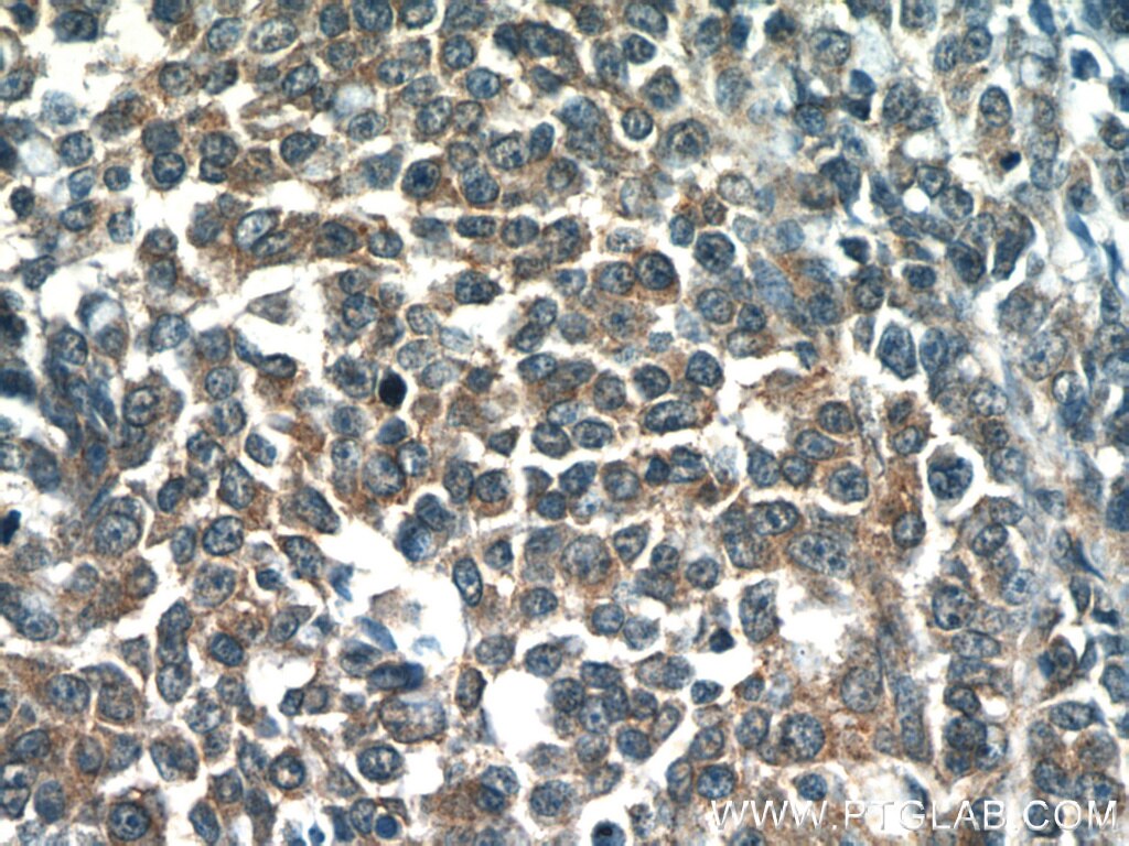 IHC staining of human colon cancer using 11879-1-AP