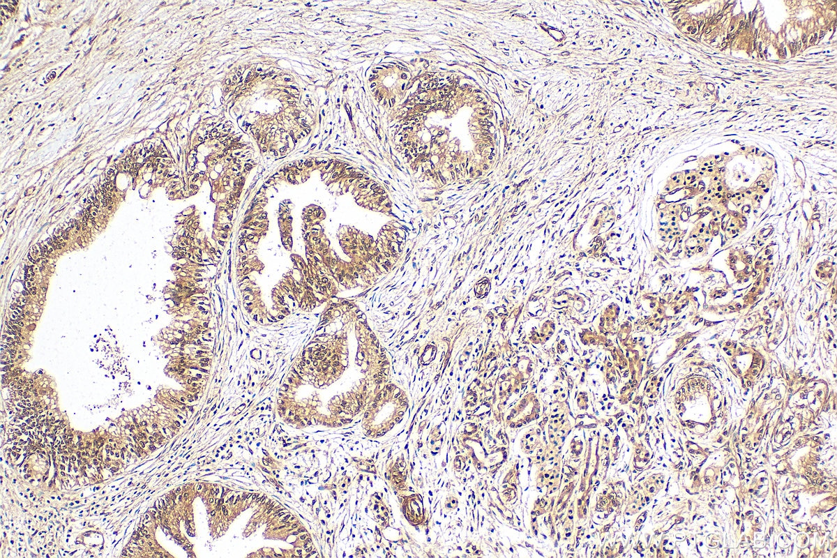 Immunohistochemistry (IHC) staining of human pancreas cancer tissue using OSGEP Polyclonal antibody (15033-1-AP)