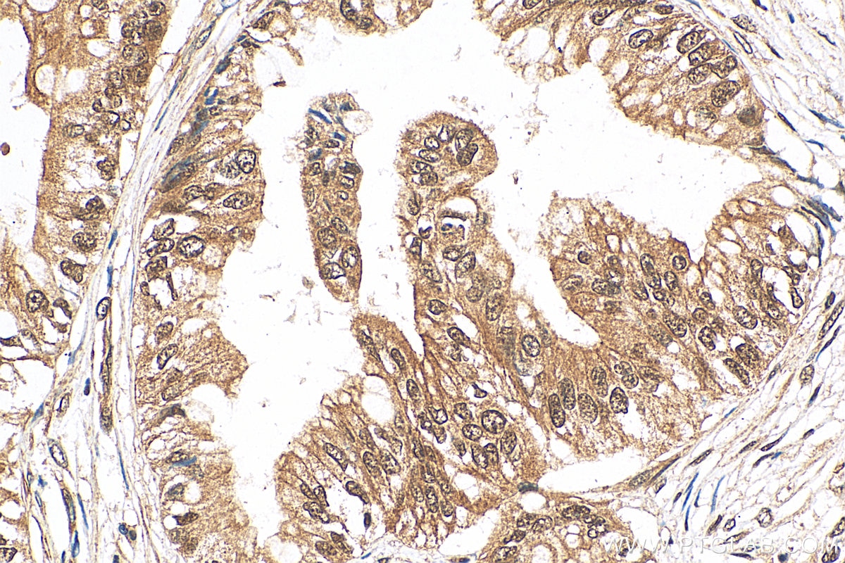 Immunohistochemistry (IHC) staining of human pancreas cancer tissue using OSGEP Polyclonal antibody (15033-1-AP)