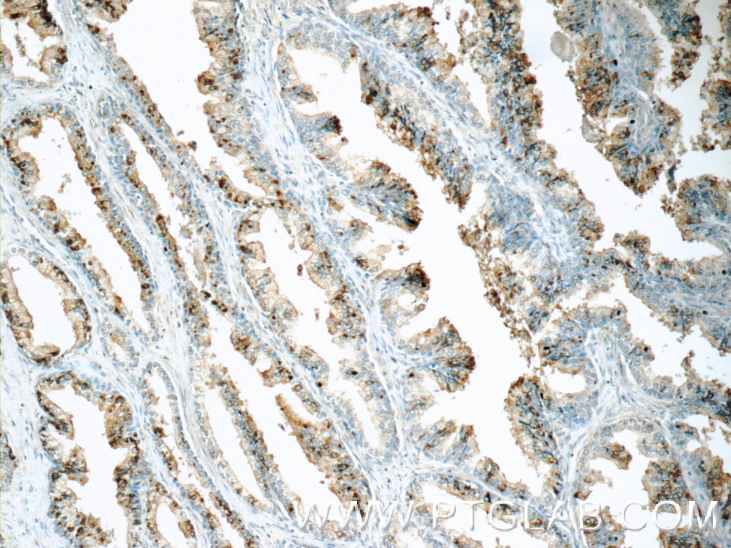 Immunohistochemistry (IHC) staining of human prostate hyperplasia tissue using OSGEPL1 Polyclonal antibody (25694-1-AP)