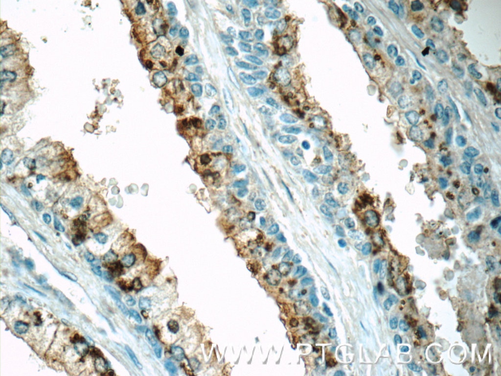 Immunohistochemistry (IHC) staining of human prostate hyperplasia tissue using OSGEPL1 Polyclonal antibody (25694-1-AP)