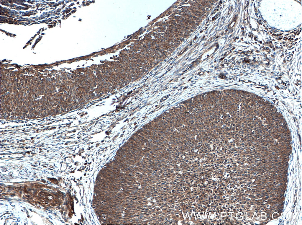 Immunohistochemistry (IHC) staining of human cervical cancer tissue using oncostatin M Polyclonal antibody (27792-1-AP)