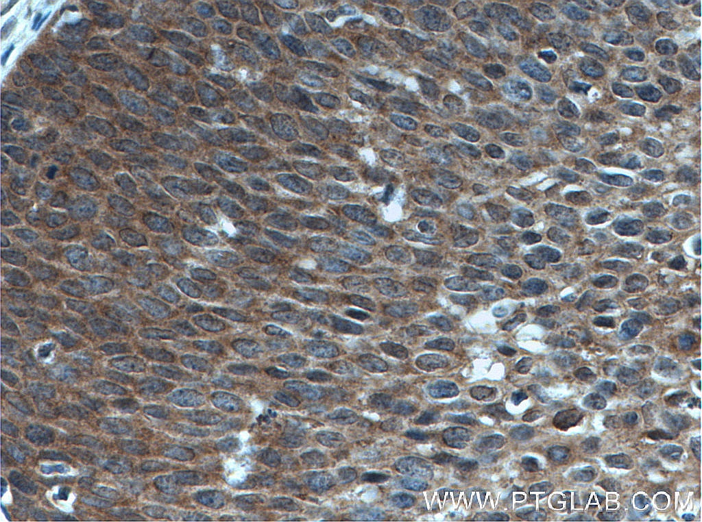 Immunohistochemistry (IHC) staining of human cervical cancer tissue using OSM Polyclonal antibody (27792-1-AP)