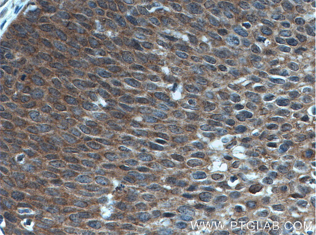 Immunohistochemistry (IHC) staining of human cervical cancer tissue using oncostatin M Polyclonal antibody (27792-1-AP)