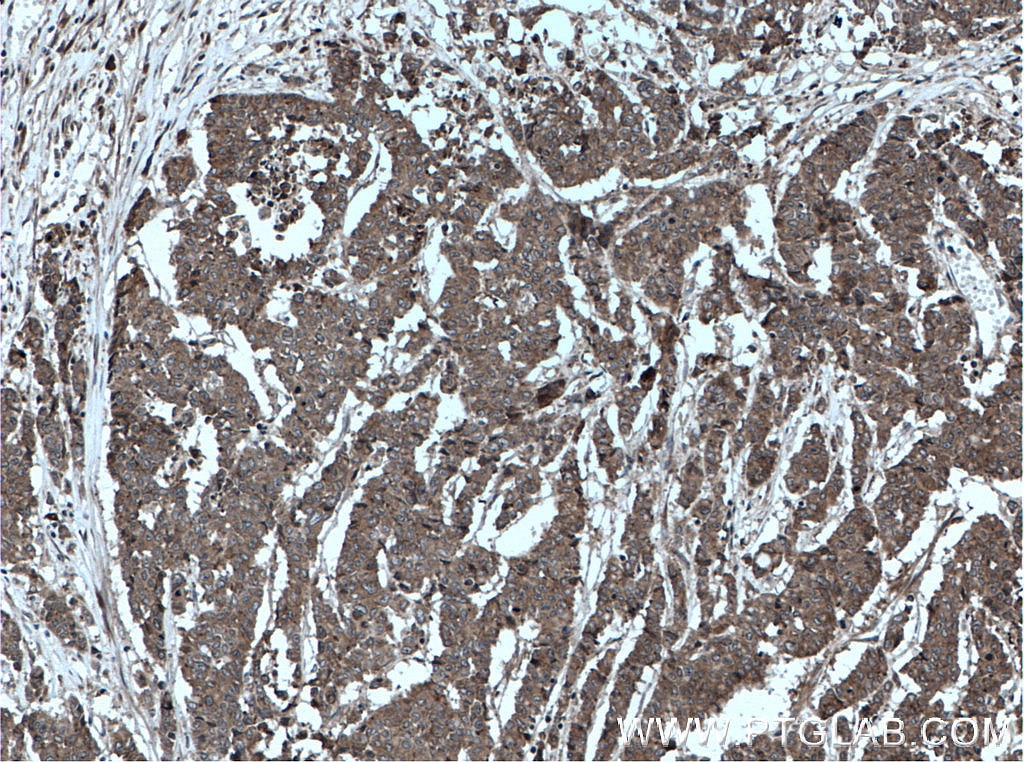 Immunohistochemistry (IHC) staining of human colon cancer tissue using OSM Polyclonal antibody (27792-1-AP)