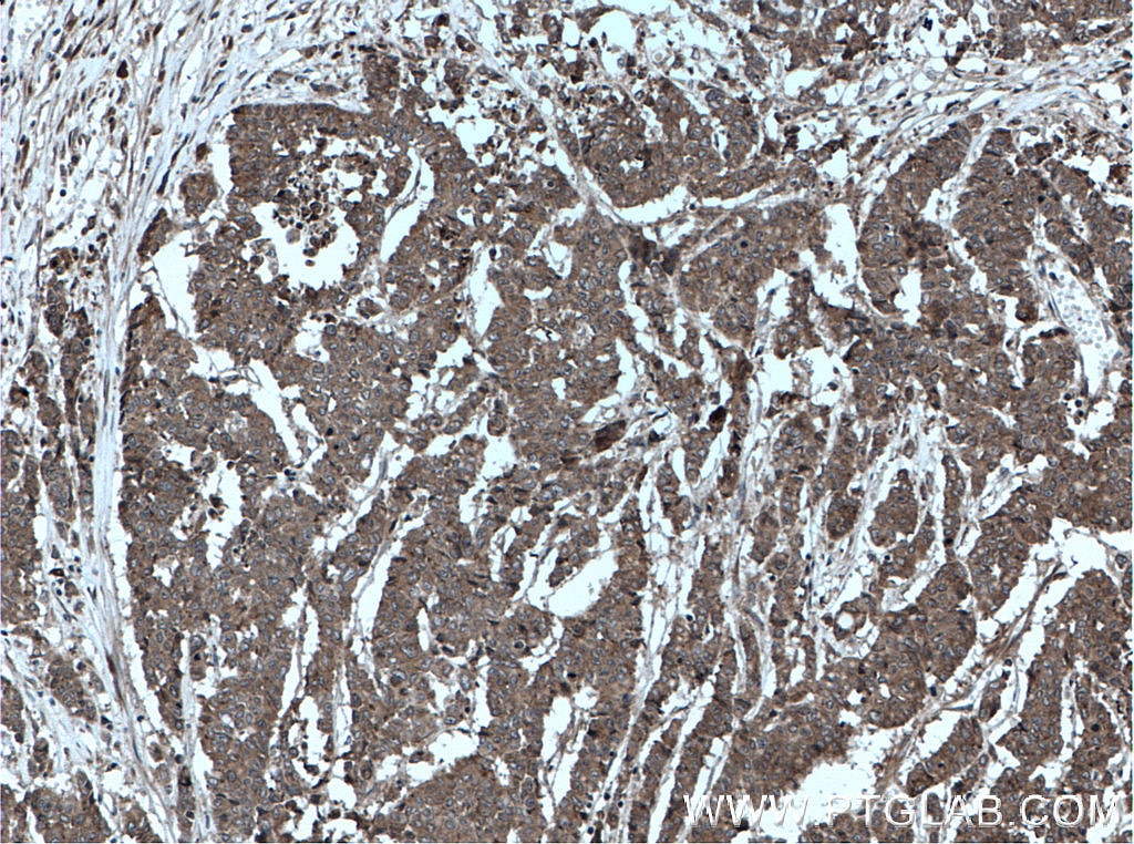 Immunohistochemistry (IHC) staining of human colon cancer tissue using oncostatin M Polyclonal antibody (27792-1-AP)