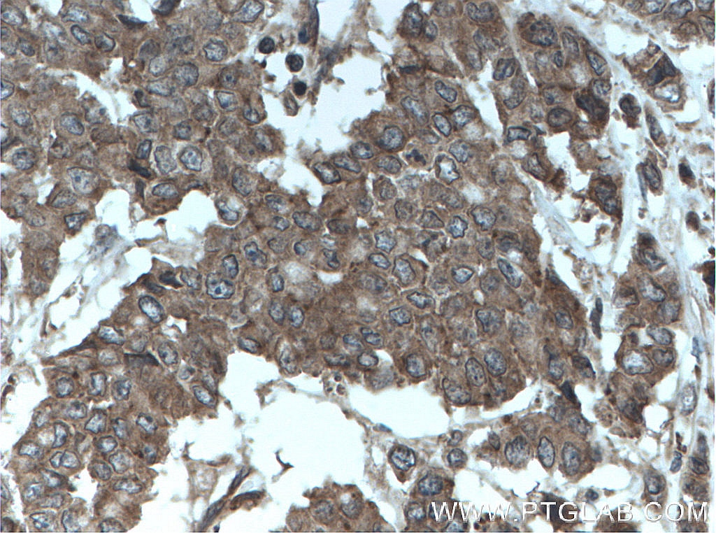 Immunohistochemistry (IHC) staining of human colon cancer tissue using oncostatin M Polyclonal antibody (27792-1-AP)