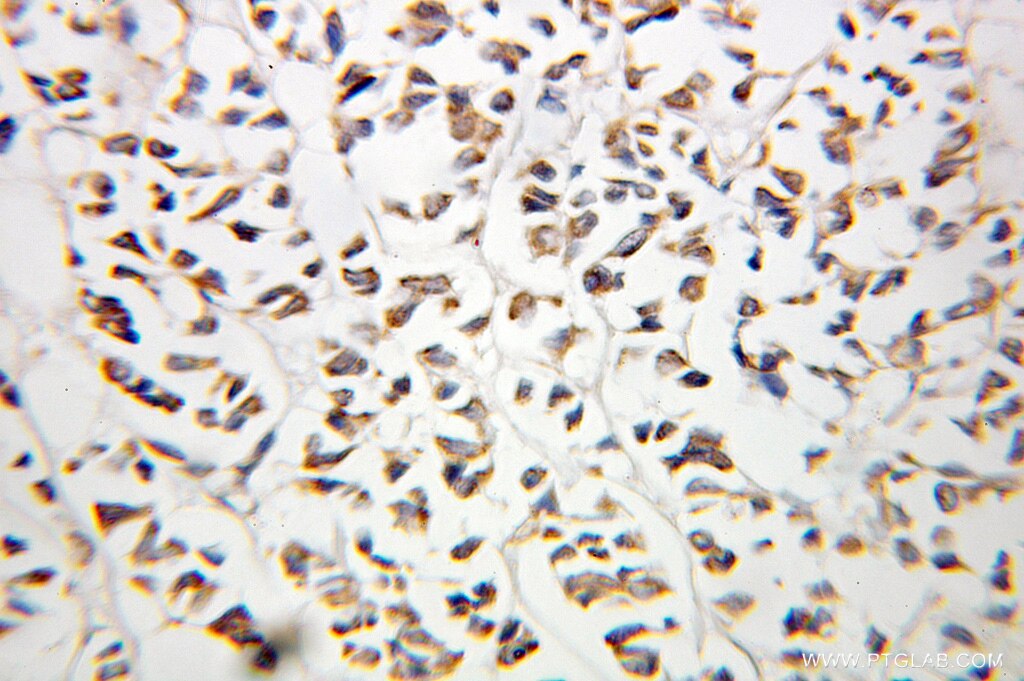 Immunohistochemistry (IHC) staining of human breast cancer tissue using OSTF1 Polyclonal antibody (10671-1-AP)