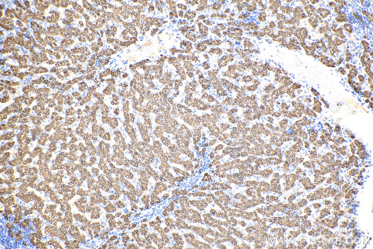 Immunohistochemistry (IHC) staining of human liver cancer tissue using OTC Polyclonal antibody (26470-1-AP)