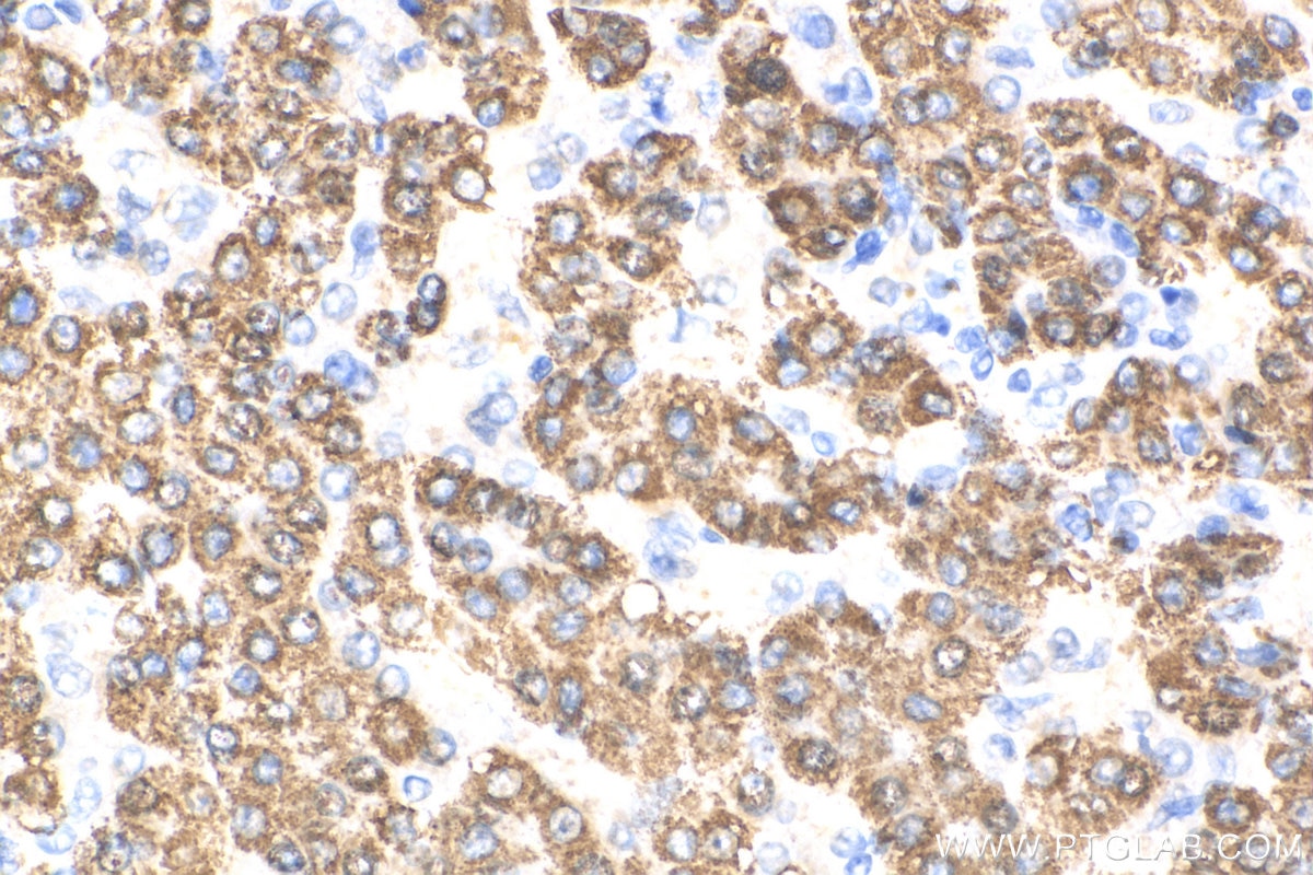 Immunohistochemistry (IHC) staining of human liver cancer tissue using OTC Polyclonal antibody (26470-1-AP)