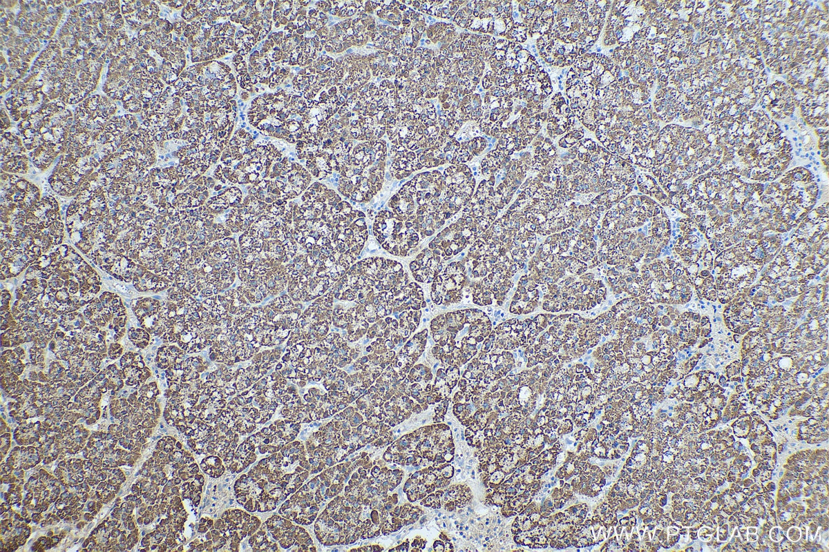 Immunohistochemistry (IHC) staining of human liver cancer tissue using OTC Monoclonal antibody (67553-1-Ig)