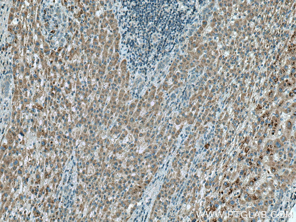 IHC staining of human liver cancer using 18132-1-AP