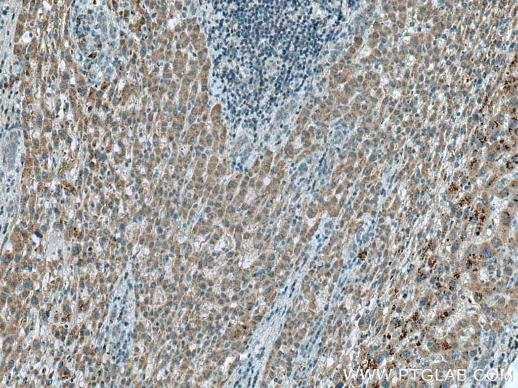 Immunohistochemistry (IHC) staining of human liver cancer tissue using OTOR Polyclonal antibody (18132-1-AP)
