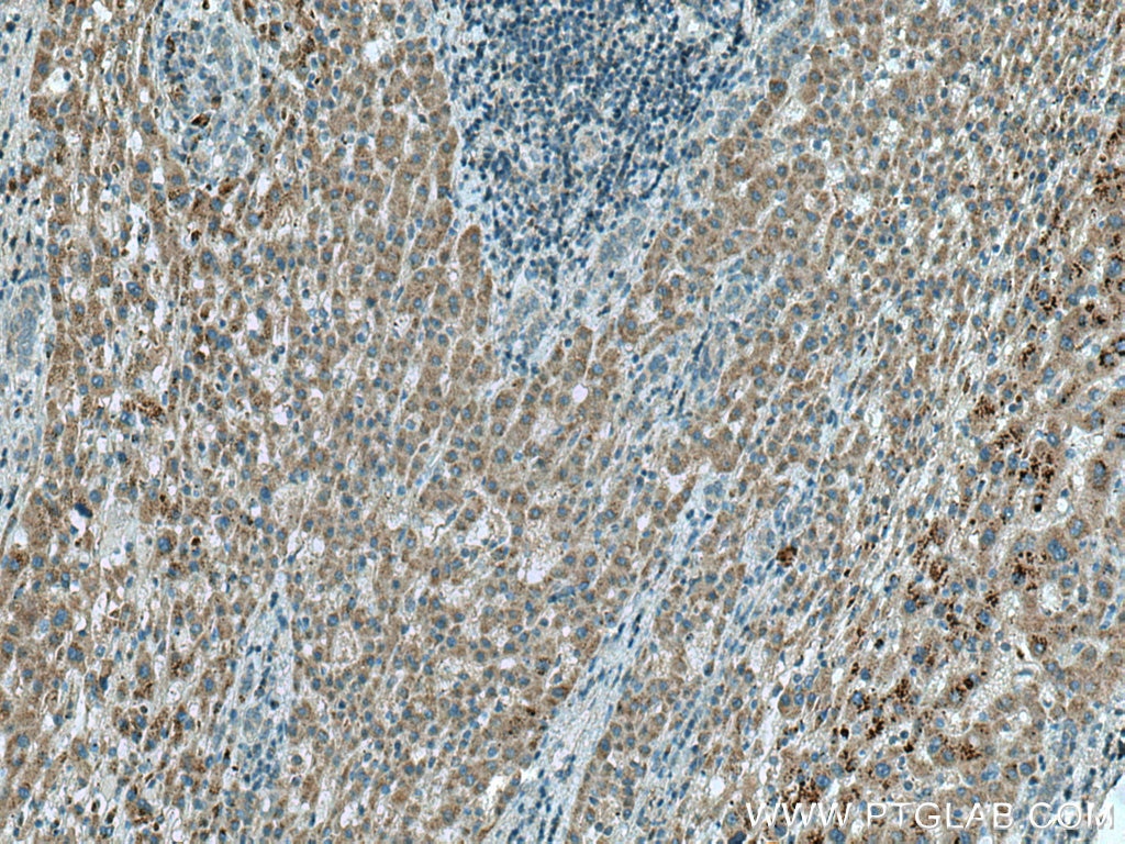 Immunohistochemistry (IHC) staining of human liver cancer tissue using OTOR Polyclonal antibody (18132-1-AP)