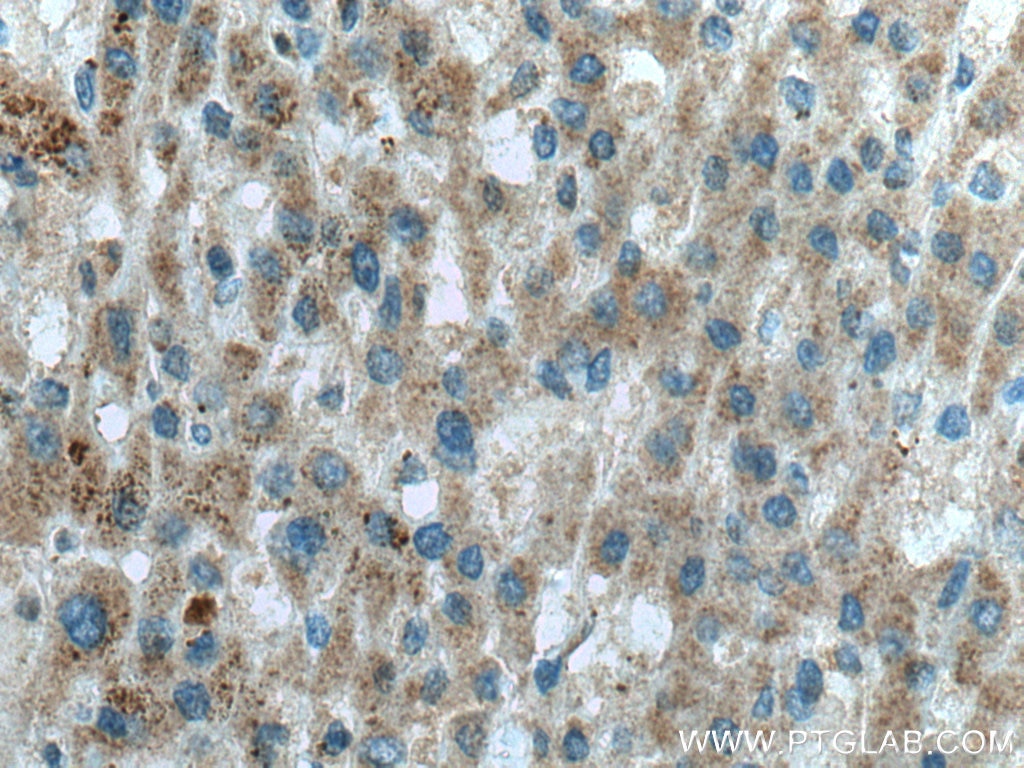 Immunohistochemistry (IHC) staining of human liver cancer tissue using OTOR Polyclonal antibody (18132-1-AP)