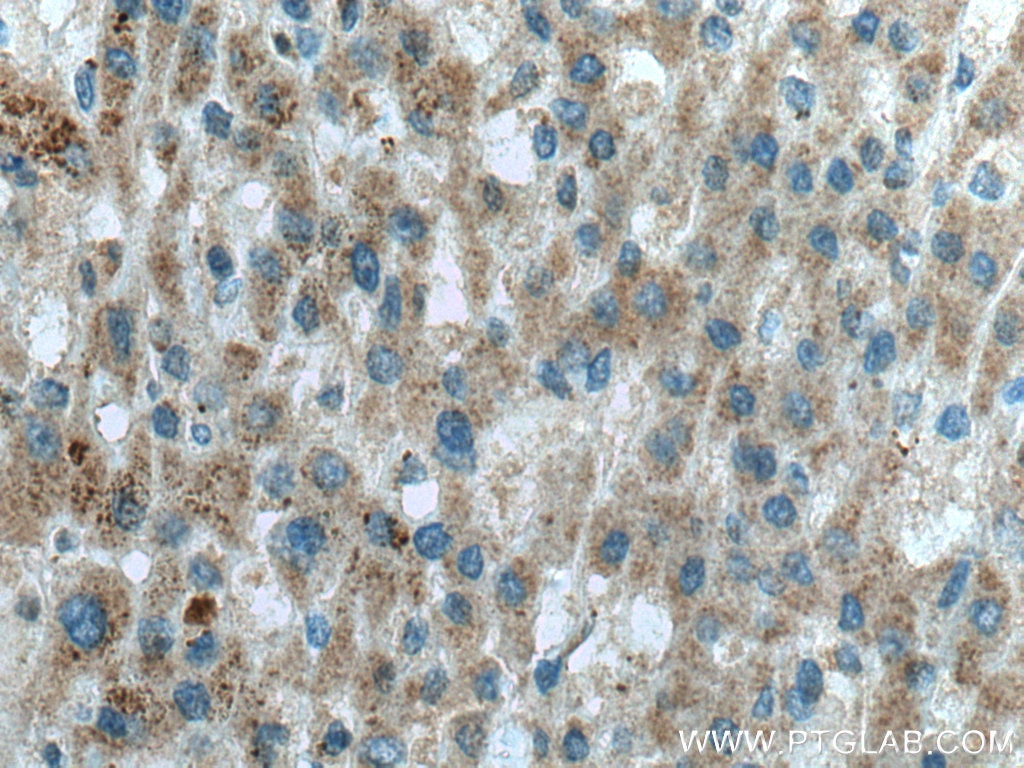 IHC staining of human liver cancer using 18132-1-AP