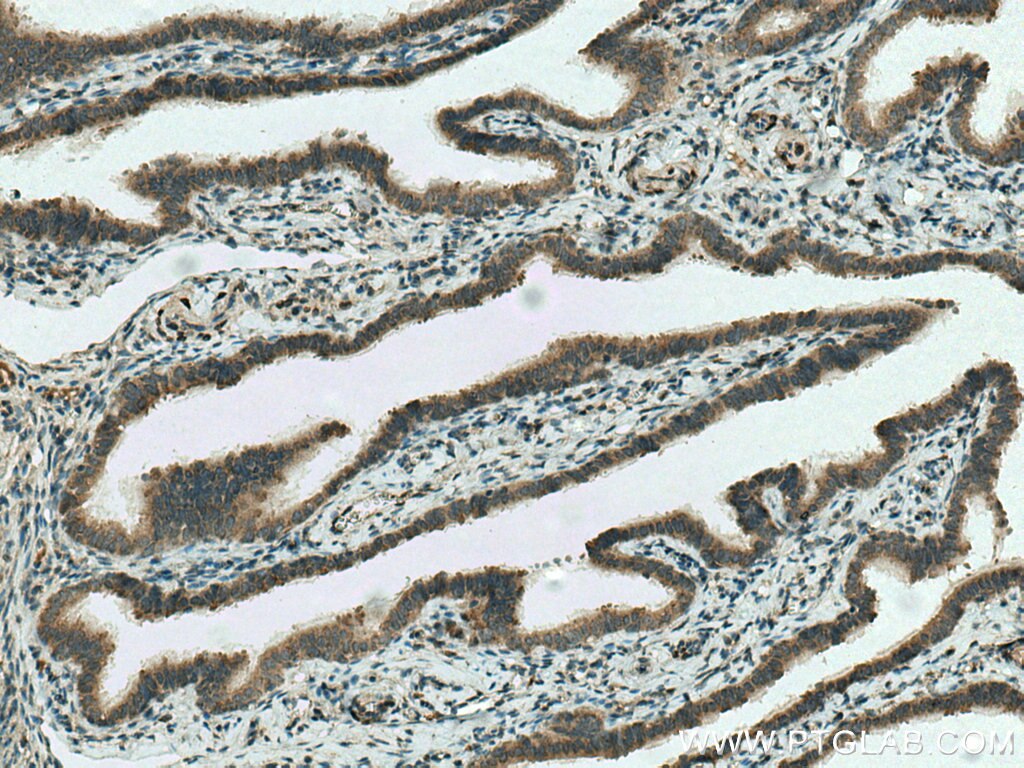 Immunohistochemistry (IHC) staining of human ovary tumor tissue using OTOR Polyclonal antibody (18132-1-AP)
