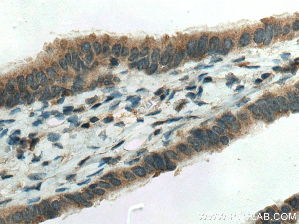 Immunohistochemistry (IHC) staining of human ovary tumor tissue using OTOR Polyclonal antibody (18132-1-AP)