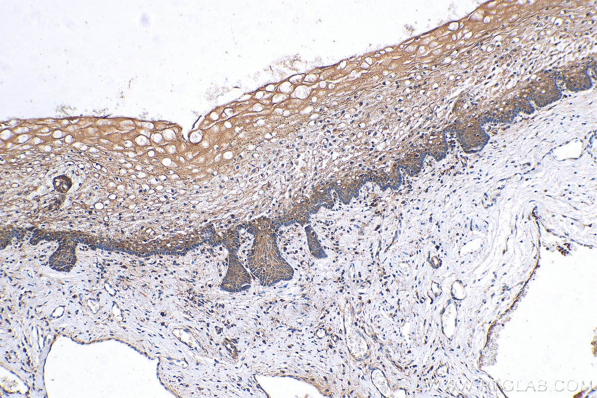 Immunohistochemistry (IHC) staining of human cervical cancer tissue using OTUD1 Polyclonal antibody (29921-1-AP)