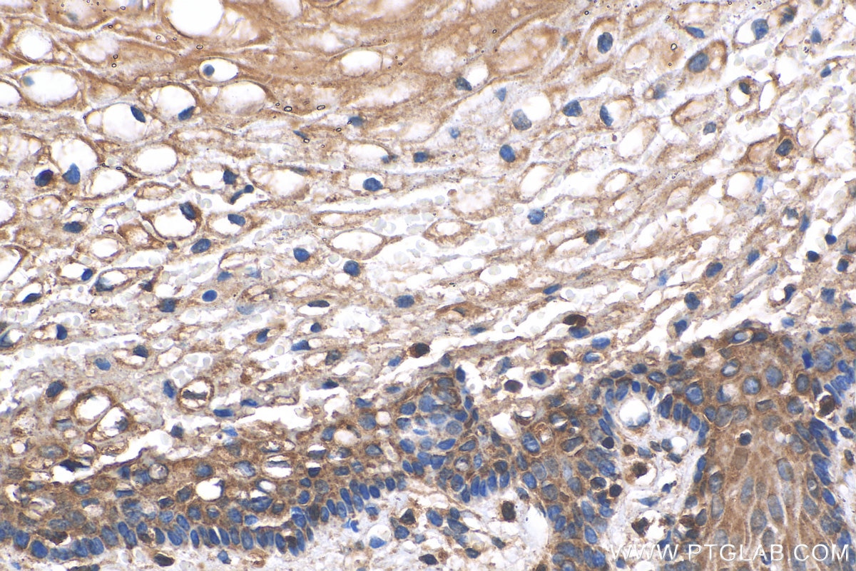 Immunohistochemistry (IHC) staining of human cervical cancer tissue using OTUD1 Polyclonal antibody (29921-1-AP)