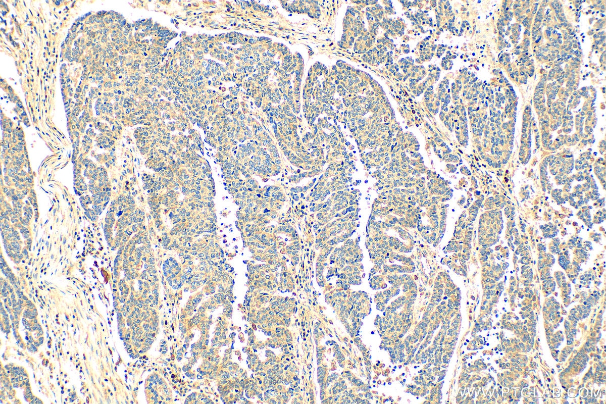 Immunohistochemistry (IHC) staining of human ovary tumor tissue using OTUD1 Polyclonal antibody (29921-1-AP)