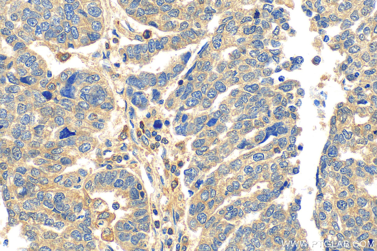 Immunohistochemistry (IHC) staining of human ovary tumor tissue using OTUD1 Polyclonal antibody (29921-1-AP)