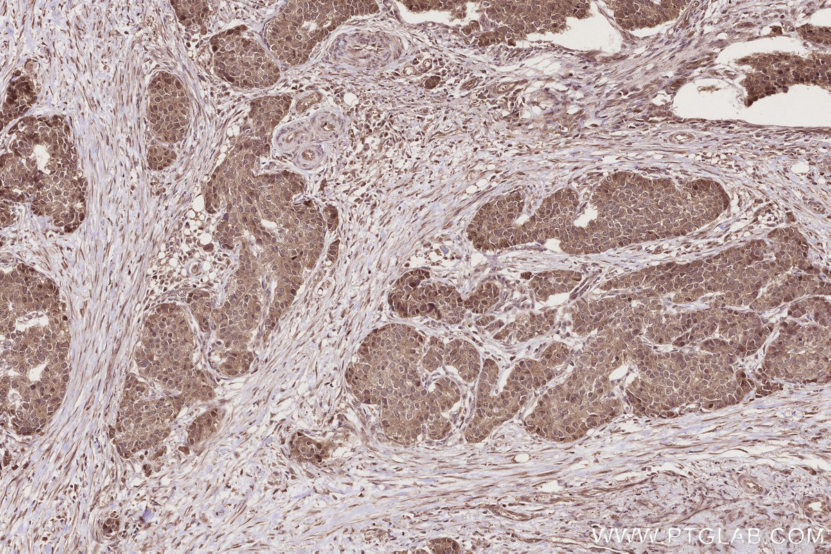 Immunohistochemistry (IHC) staining of human stomach cancer tissue using OTUD5 Polyclonal antibody (21002-1-AP)
