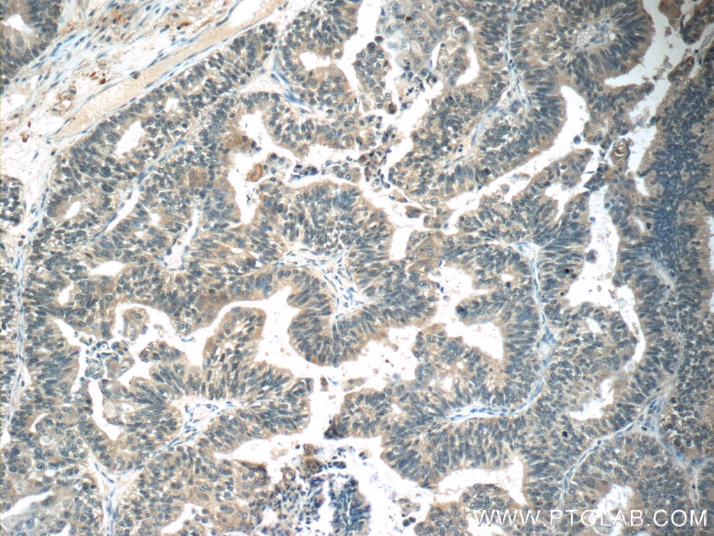 Immunohistochemistry (IHC) staining of human ovary tumor tissue using OTUD6B Polyclonal antibody (25430-1-AP)