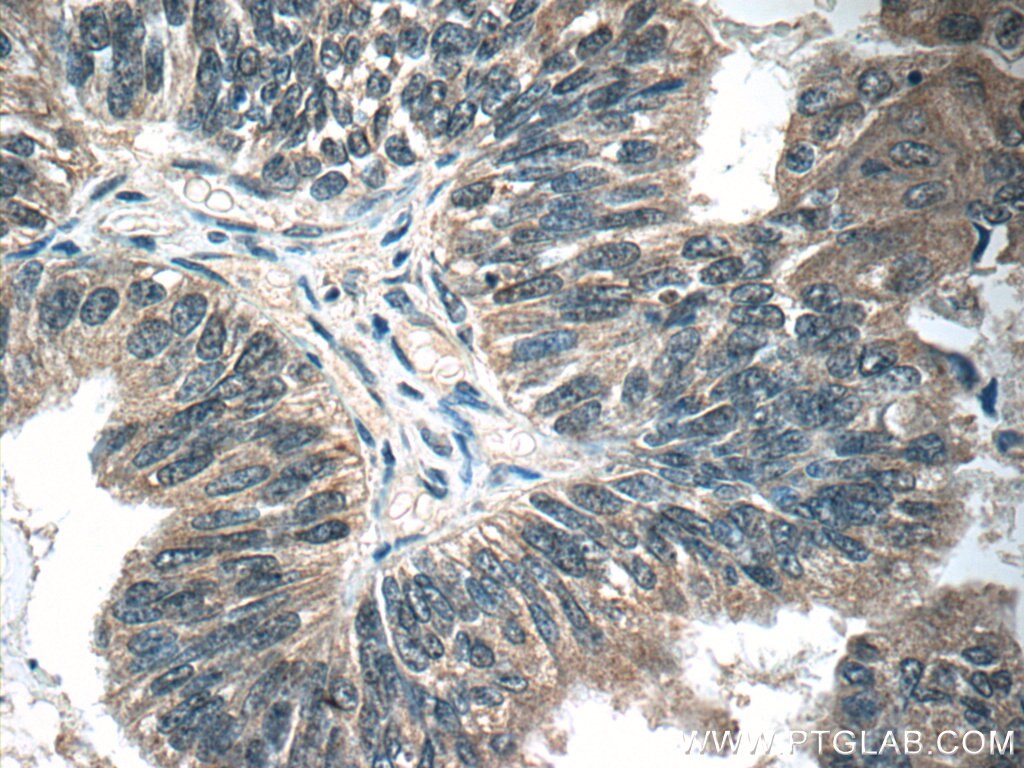 Immunohistochemistry (IHC) staining of human ovary tumor tissue using OTUD6B Polyclonal antibody (25430-1-AP)