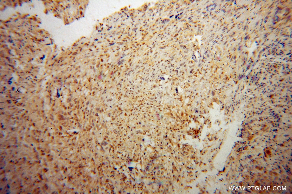 Immunohistochemistry (IHC) staining of human gliomas tissue using OTX2 Polyclonal antibody (13497-1-AP)