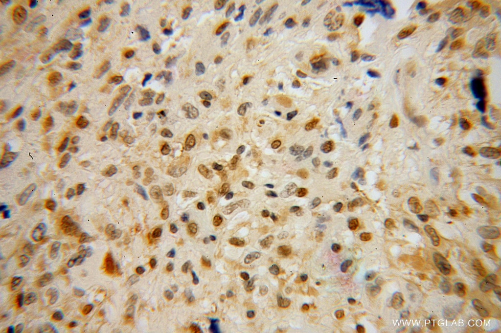 Immunohistochemistry (IHC) staining of human gliomas tissue using OTX2 Polyclonal antibody (13497-1-AP)