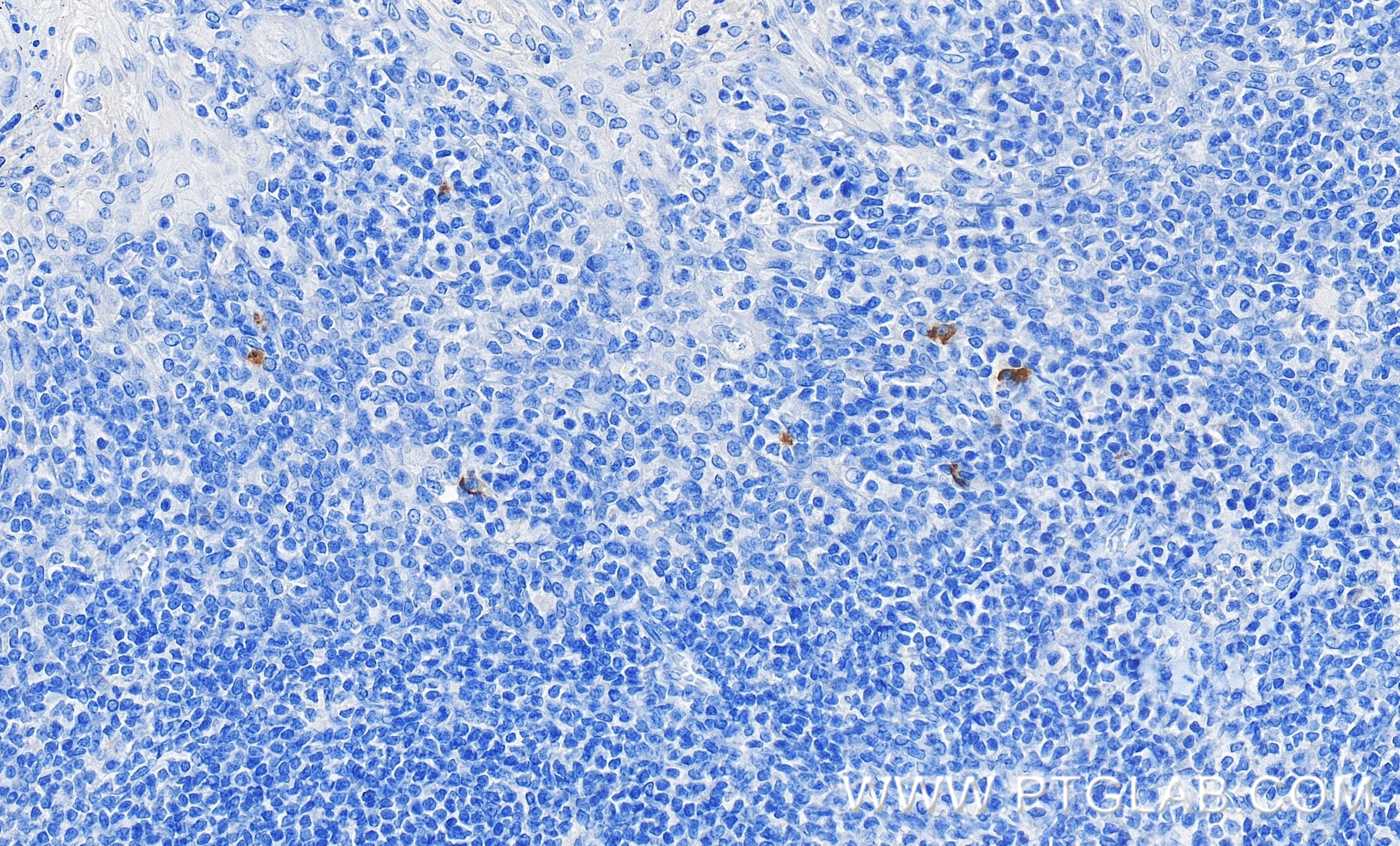 Immunohistochemical analysis of paraffin-embedded human tonsillitis tissue slide using 82794-7-RR (OX40L/TNFSF4 antibody) at dilution of 1:1000 (under 40x lens). Heat mediated antigen retrieval with Tris-EDTA buffer (pH 9.0). Immunohistochemistry (IHC) staining of human tonsillitis tissue using OX40L/TNFSF4 Recombinant monoclonal antibody (82794-7-RR)