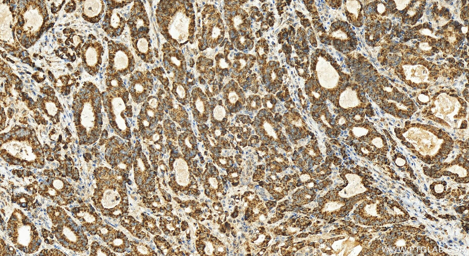 Immunohistochemistry (IHC) staining of human stomach cancer tissue using OXA1L Polyclonal antibody (21055-1-AP)